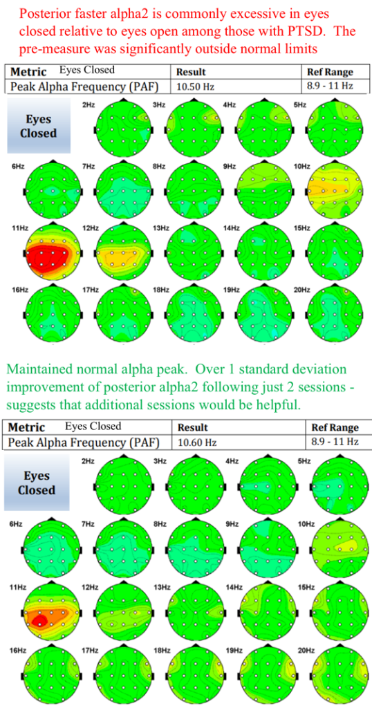 qEEG from Evoke Neuroscience